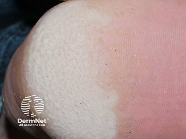 Gambar 1: Pitted Keratolysis. Credit: Dermnetnz.org